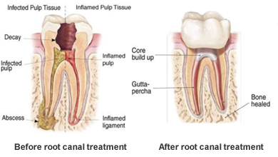 Diagram showing before and after root canal treatment