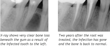 X-ray photos - before and after treatment